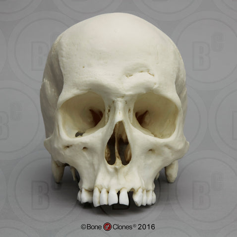 Forensic Skull: Cast Replica Human Male Skull with Hammer blows - Homo sapiens #BC-217