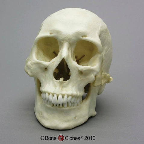 Forensic Skull: Cast Replica Human Skull with Healed Trauma - Homo sapiens #BC-303