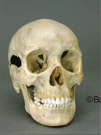 Forensic Skull: Cast Replica Human Female Skull with Multiple Gunshot Wounds - Homo sapiens #BC-202