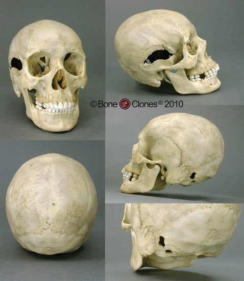 Forensic Skull: Cast Replica Human Female Skull with Multiple Gunshot Wounds - Homo sapiens #BC-202