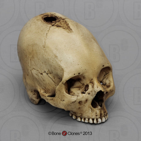 Historic Skull: Cast Replica Bound & Trephinated Human Skull - Homo sapiens #BC-115