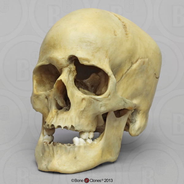 Forensic Skull: Cast Replica Gunshot wound Human Skull - Homo sapiens #BC-152