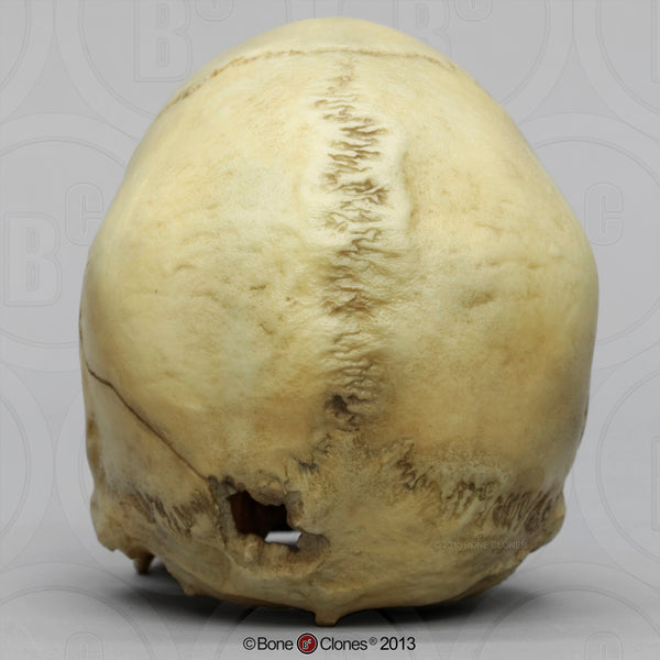 Forensic Skull: Cast Replica Gunshot wound Human Skull - Homo sapiens #BC-152