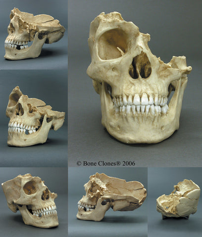 Forensic Skull: Cast Replica Machete wound Human Skull - Homo sapiens #BC-185
