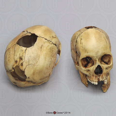 Forensic Skull: Cast Replica Shotgun wound Human Skull - Homo sapiens #BC-196