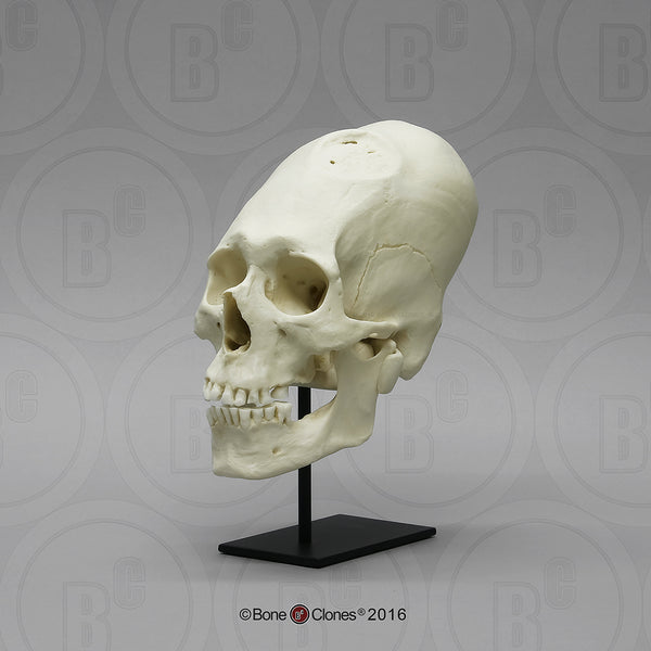 Historic Skull: Cast Replica Human Skull (Trephinated & Elongated Peruvian skull) - Homo sapiens #BC-201